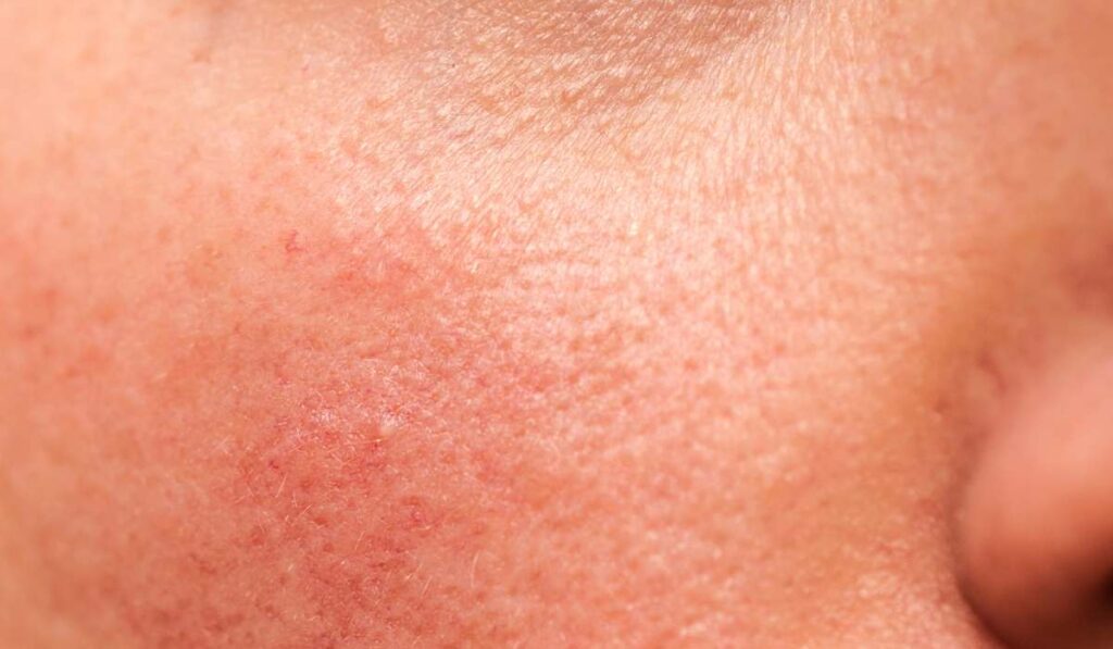 Natural skin treatments article: Irritated skin