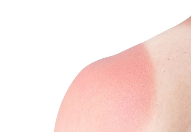 Genius Sunburn Remedies That Work FAST: Natural Relief with Aloe, ACV & More (At Home)