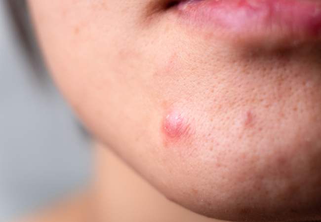 What Not to Do If You Have a Deep Pimple (With Helpful Tips That Actually Work)
